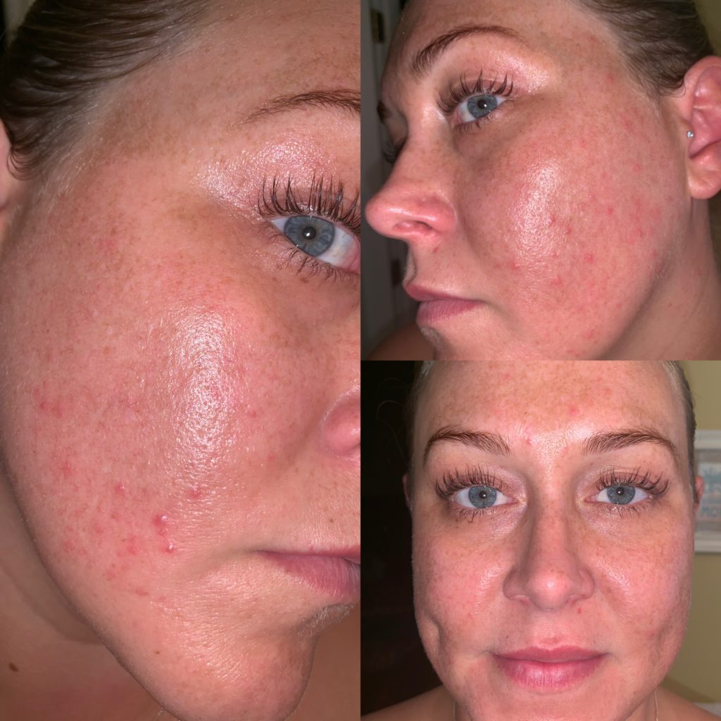 Lindsey Chemical Peel