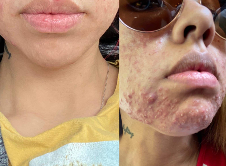Acne treatment with chemical peels and skincare at Smoothe & Co. in Raleigh, NC