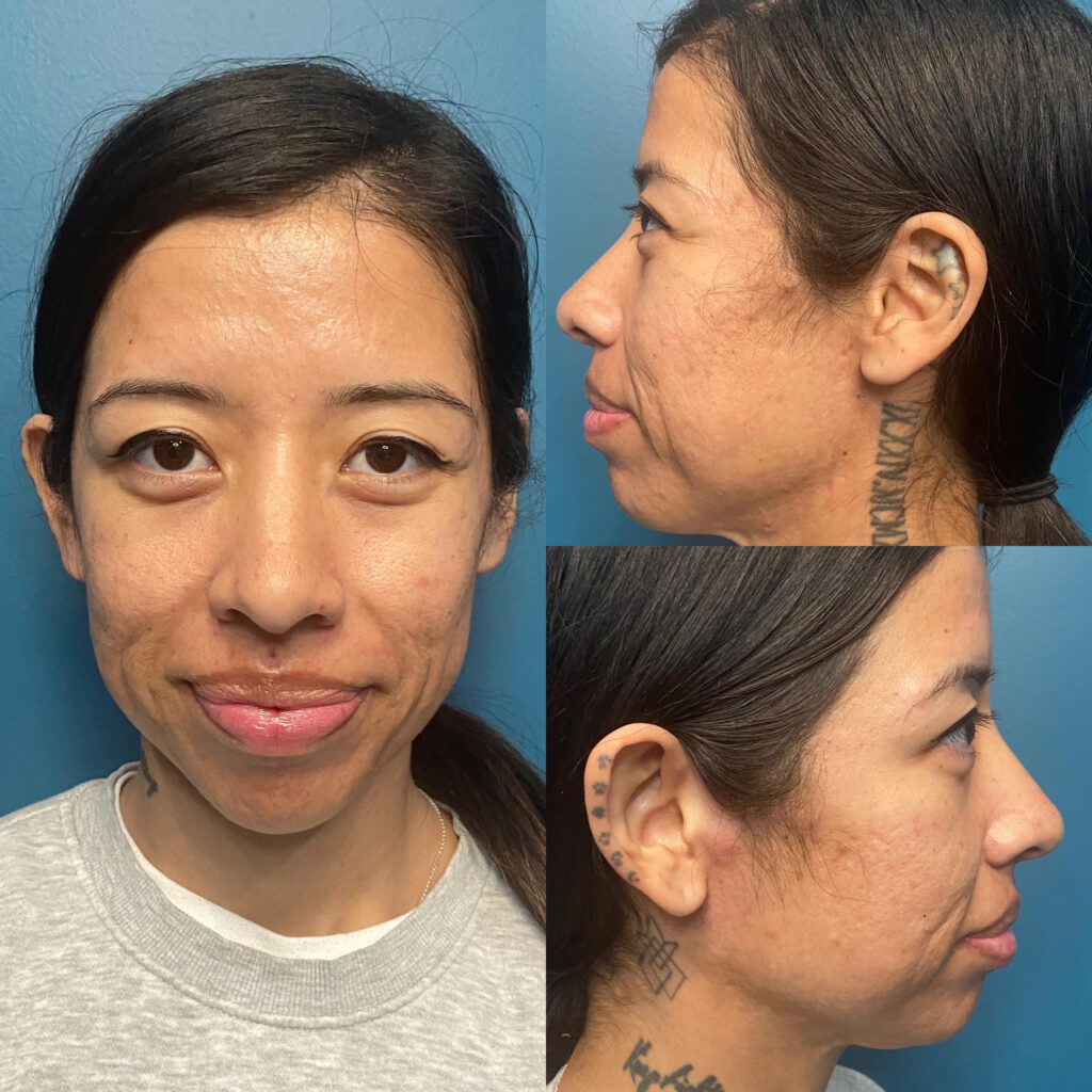 2023-04 - Smoothe Before and After Results - Elena - 02