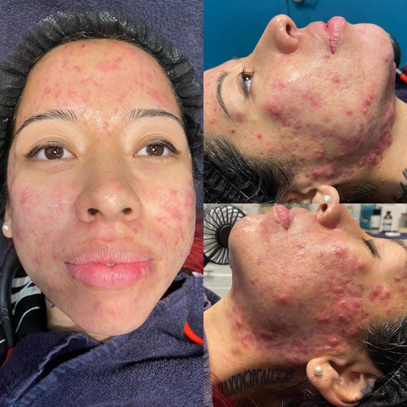 2023-04 - Smoothe Before and After Results - Elena