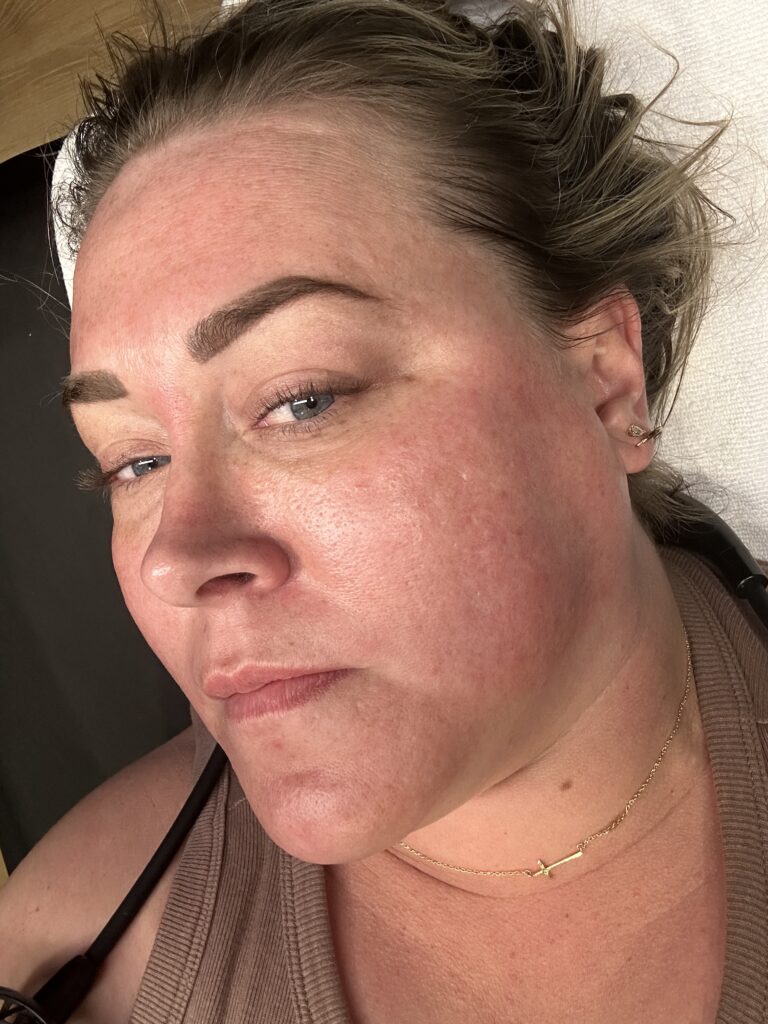 Melasma treated at Smoothe & Co. in Raleigh, NC.