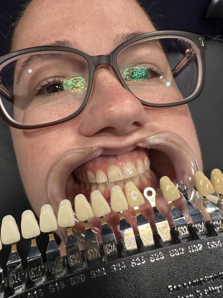 Whiter Teeth with one treatment with teeth whitening at Smoothe & Co.