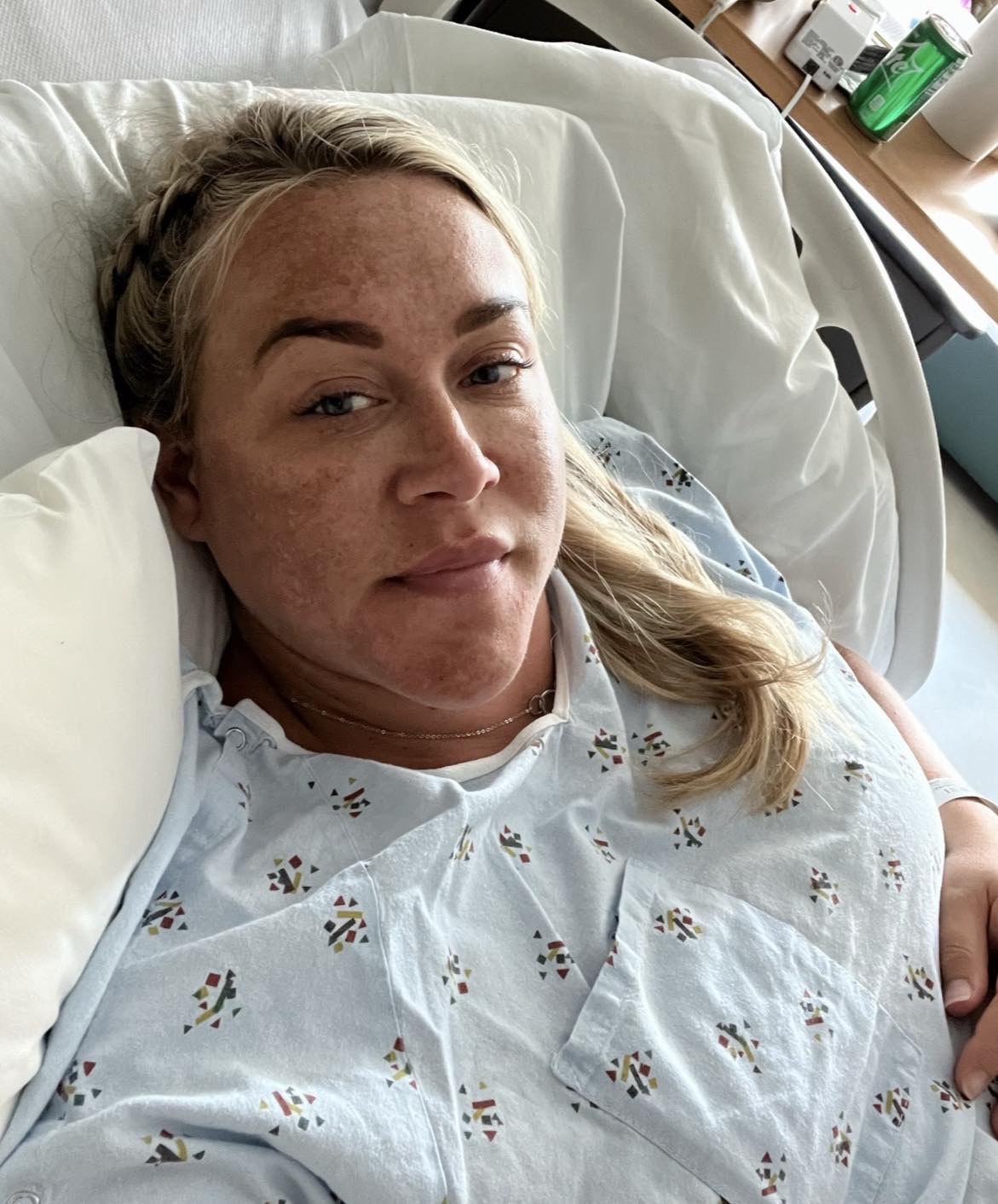 Melasma treatment in Raleigh, North Carolina at Smoothe & Co.