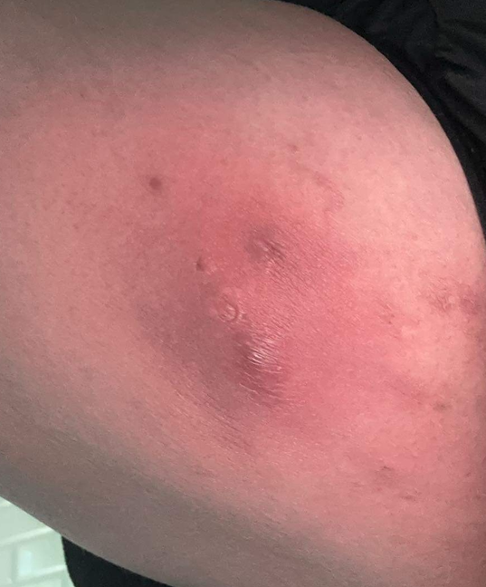 Hidradentitis Supportiva and the Raleigh Esthetician