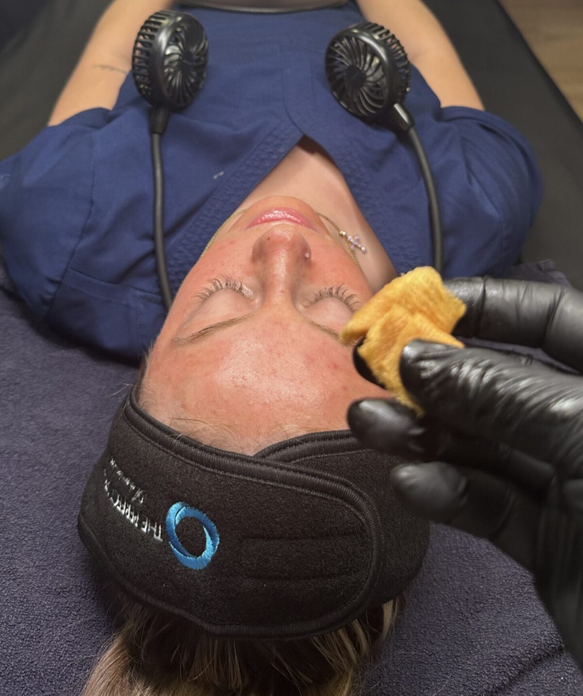 chemical peels for healthier skin in Raleigh