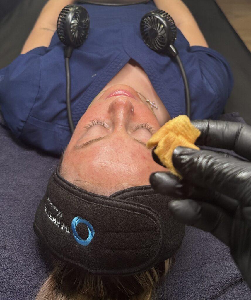 chemical peels for healthier skin in Raleigh